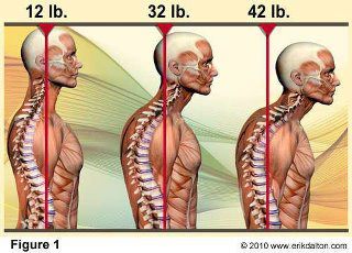 Poor posture causes stress on neck and can lead to ergonomic injuries like kyphosis